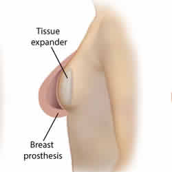 Breast Prosthesis