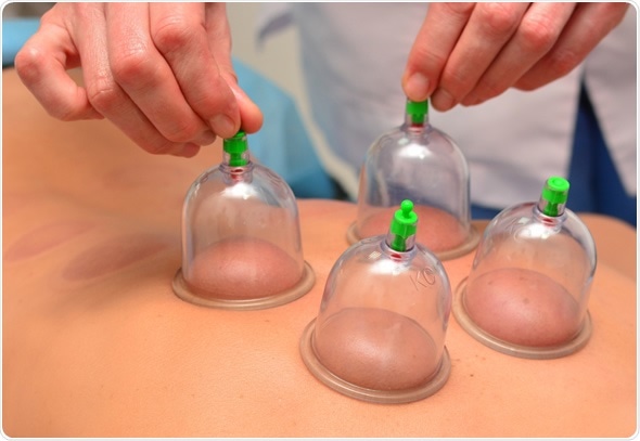 Certificate in Cupping Therapy