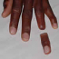 Finger Restoration