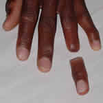 Finger Restoration